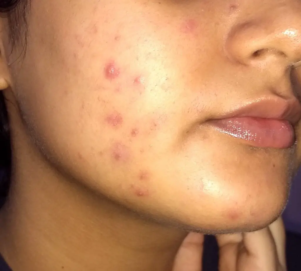 Redness Gone After Using The Ordinary Azelaic Acid Suspension
