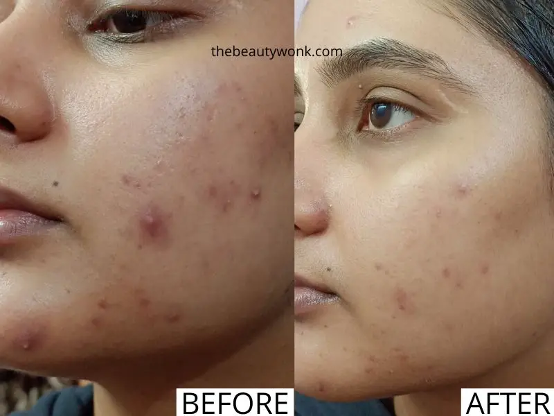 Retinol Before and After for Acne